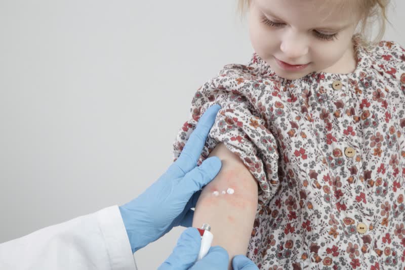Dottore con guanti in lattice blu che applica un olio sulla dermatite atopica (o prurigo di Besnier) sul braccio di una bambina che presenta uno sfogo rosso sulla pelle